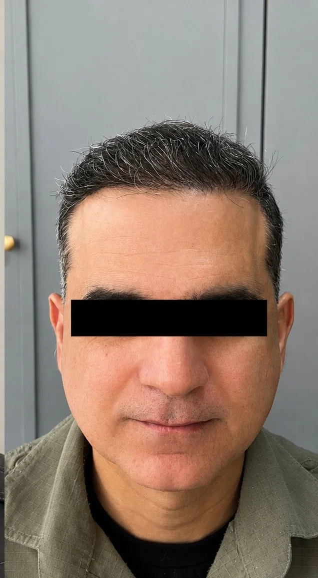 Paciente da Dra. Tainá depois do transplante FUE